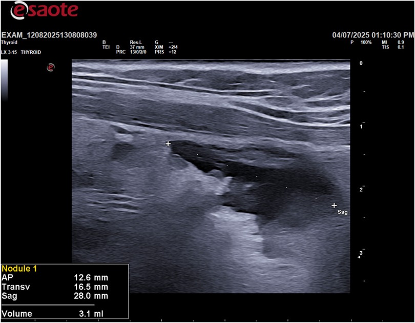 Ultrasound image of a thyroid, displaying a nodule labeled \