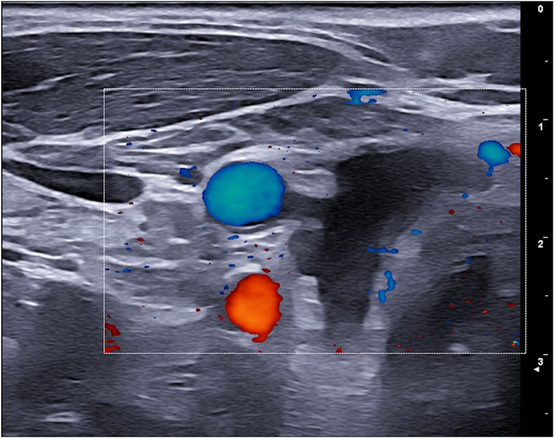 Ultrasound image showing a cross-sectional view with color Doppler mapping. Two distinct colored areas are visible: a blue circular area at the top and a red irregular-shaped area at the bottom, indicating blood flow direction and speed. Grayscale layers indicate tissue structures.