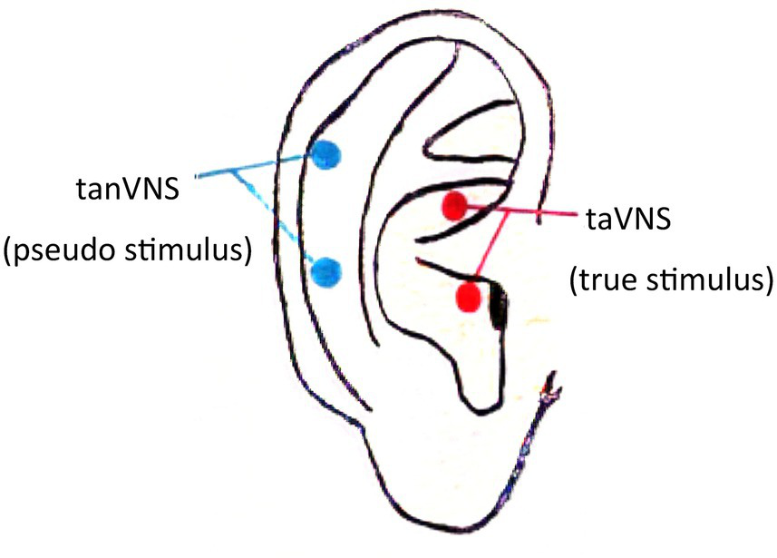Illustration of an ear diagram showing the locations for transcutaneous auricular vagus nerve stimulation (taVNS, true stimulus) and transcutaneous auricular nonvagus nerve stimulation (tanVNS, pseudo stimulus). Red dots indicate true stimulation points (taVNS), and blue dots indicate pseudo stimulation points (tanVNS).