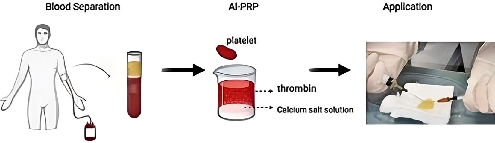 Diagram showing blood separation for AI-PRP application. Blood is drawn and separated into components. Platelets are concentrated with additives like thrombin and calcium salt solution. The final product is applied with a syringe, as shown by gloved hands in a clinical setting.