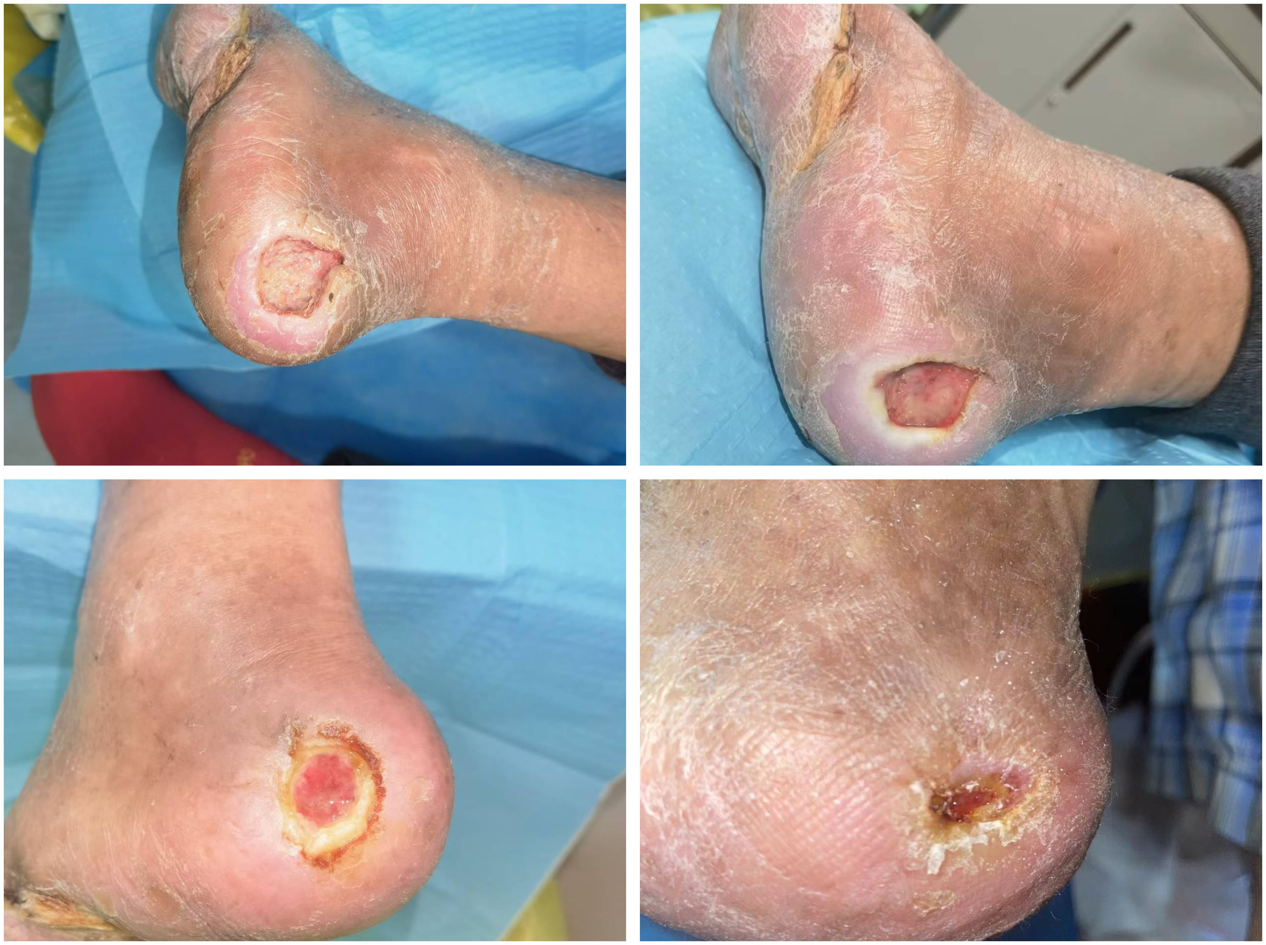Close-up images of a foot showing pressure ulcers on the heel. The ulcers vary in size and severity, with skin discoloration, peeling, and open sores visible. The images illustrate different stages of the condition.