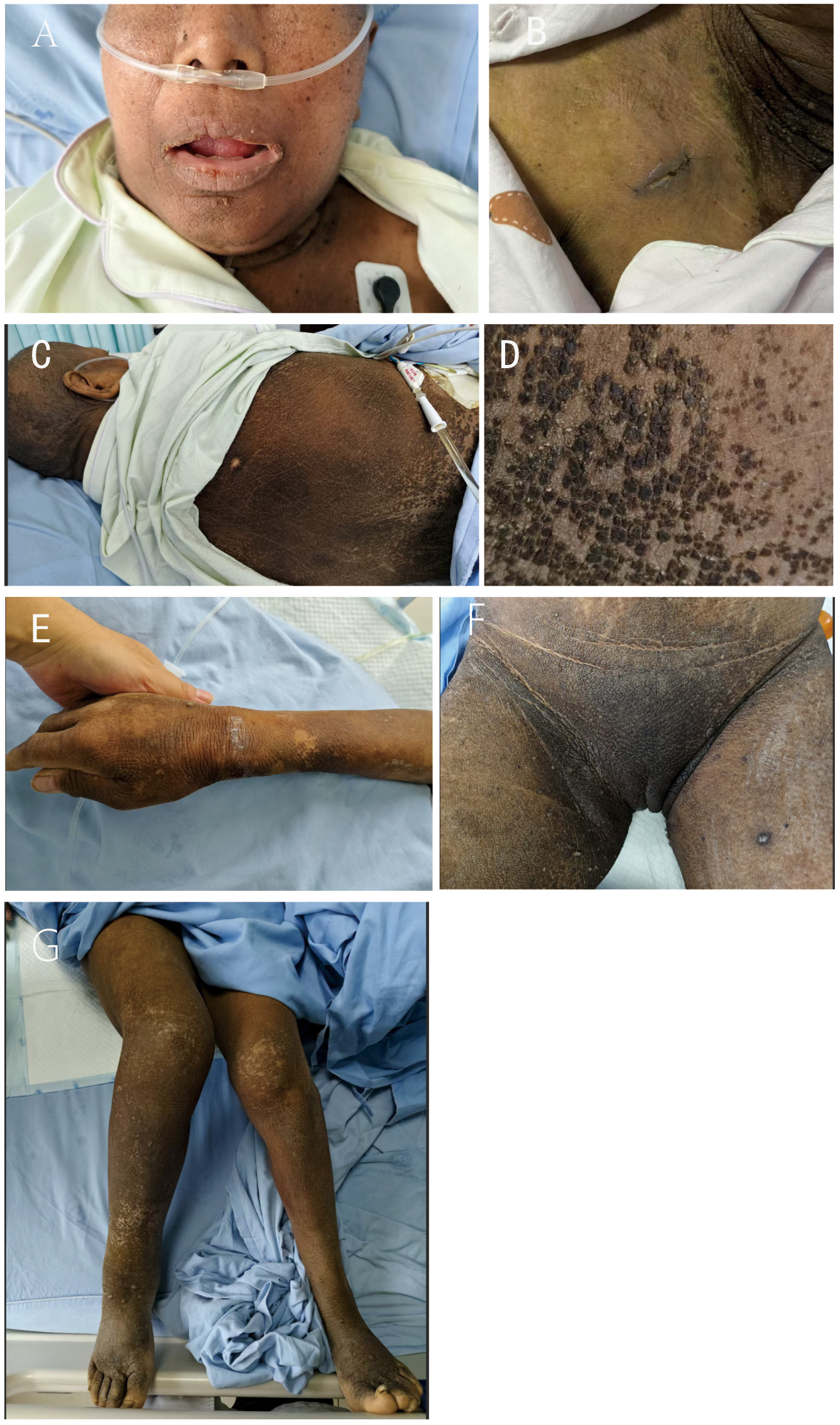 A series of medical images showing various affected areas of a patient's skin. A: The patient's face with nasal cannula. B: Discolored skin near the neck. C: Darkened back skin with attached medical equipment. D: Close-up of textured skin. E: Arm with patchy discoloration, held by a hand. F: Darkened skin near the upper thigh. G: Legs exhibiting skin discoloration and changes. The images depict widespread skin conditions.