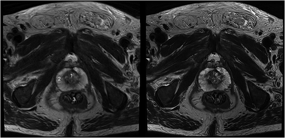 MRI images showing transverse sections through the pelvic region. The left image highlights three areas labeled with numbers one (transition zone), two (peripheral zone), and three (rectum), indicating specific anatomical structures or points of interest. The right image provides a similar view without annotations, emphasizing the consistent cross-sectional anatomy. Both images display various tissues, including muscle and fat, with distinct contrast differences.
