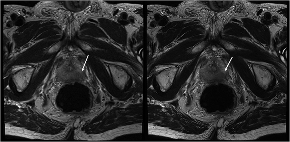 MRI scans showing two cross-sectional images side by side. Both images highlight an area with a white arrow pointing to a specific region, possibly indicating an area of interest or abnormality. The images are grayscale, detailing soft tissue structures.