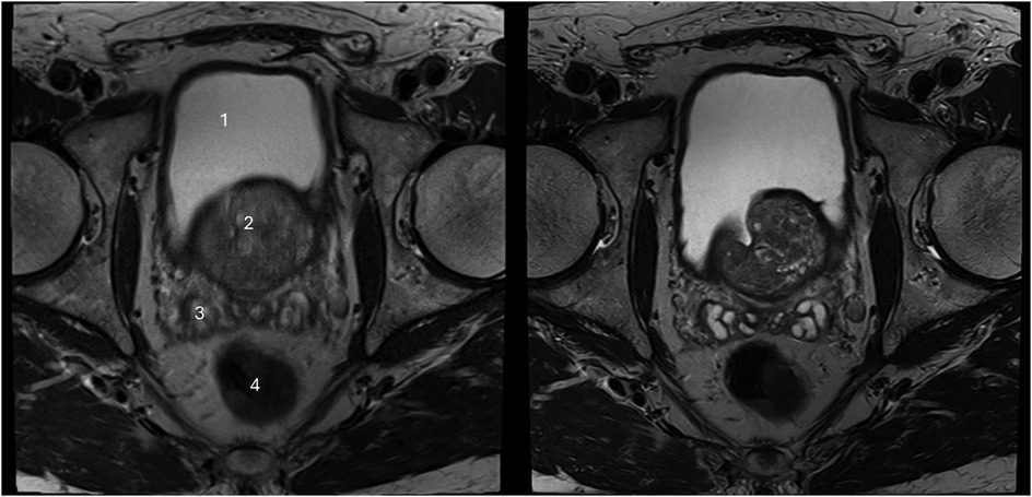 MRI scan in two panels showing the pelvic region with labeled sections. The left panel has numbers: one for the bladder, two for the prostate, three for the seminal vesicles, and four for the rectum. The right panel shows a similar pelvic view, demonstrating anatomical features without labels.