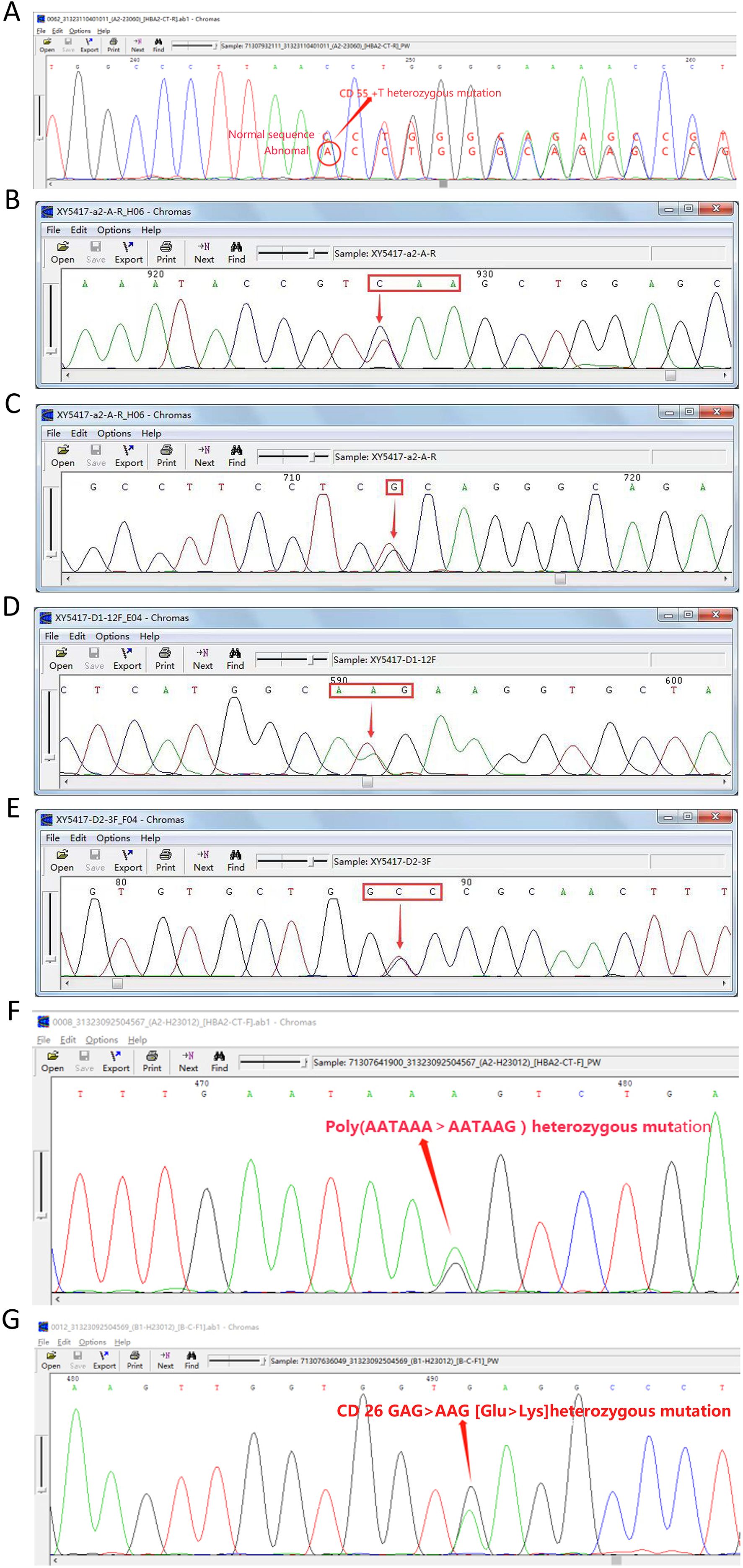 DNA sequencing chromatograms showing heterozygous mutations are labeled from A to G. A: CD 55 T mutation. B: C mutation. C: G mutation. D: G mutation. E: G mutation. F: Poly AATAAA to AATAAG mutation. G: CD 26 GAG to AAG mutation. Each panel highlights the specific mutation with red arrows and boxes within the chromatogram peaks.