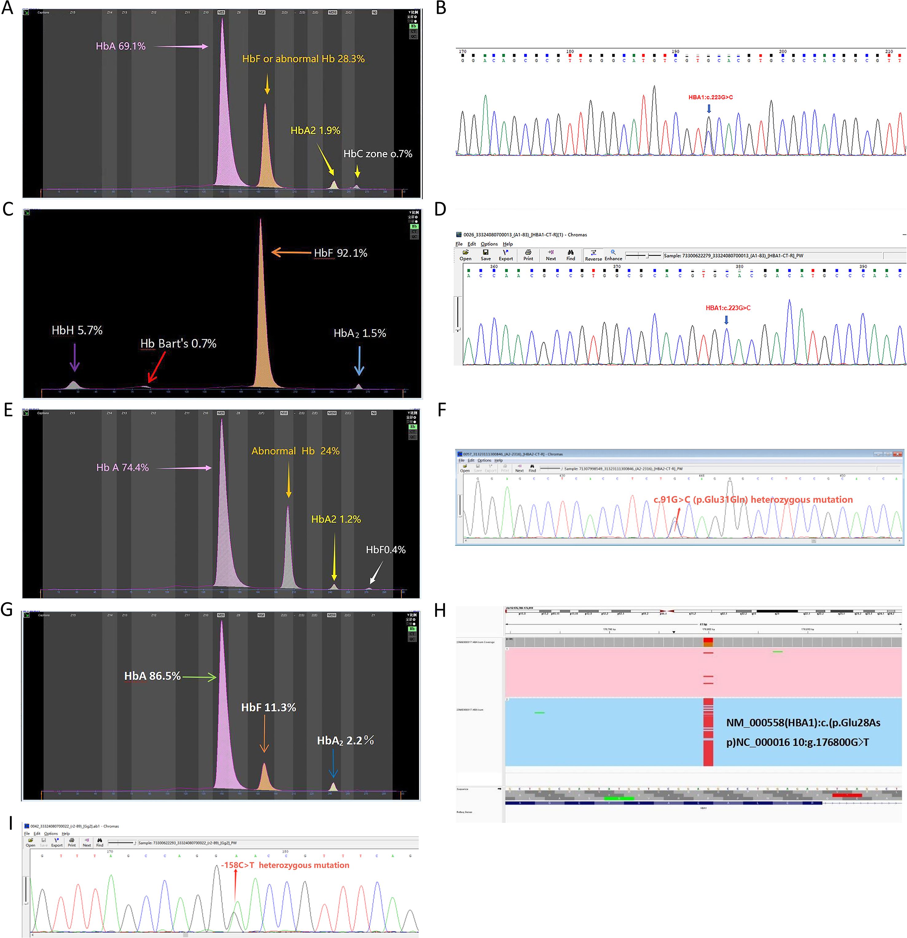 Composite image showing hemoglobin electrophoresis results and DNA sequencing chromatograms. Panels A, C, E, and G display graphs with percentage values for different hemoglobin types. Panels B, D, F, and I depict chromatograms highlighting specific mutations in DNA sequences. Panel H shows a graphical representation of genetic data with annotations. The images convey variations in hemoglobin types and genetic mutations, significant for diagnosing blood disorders.