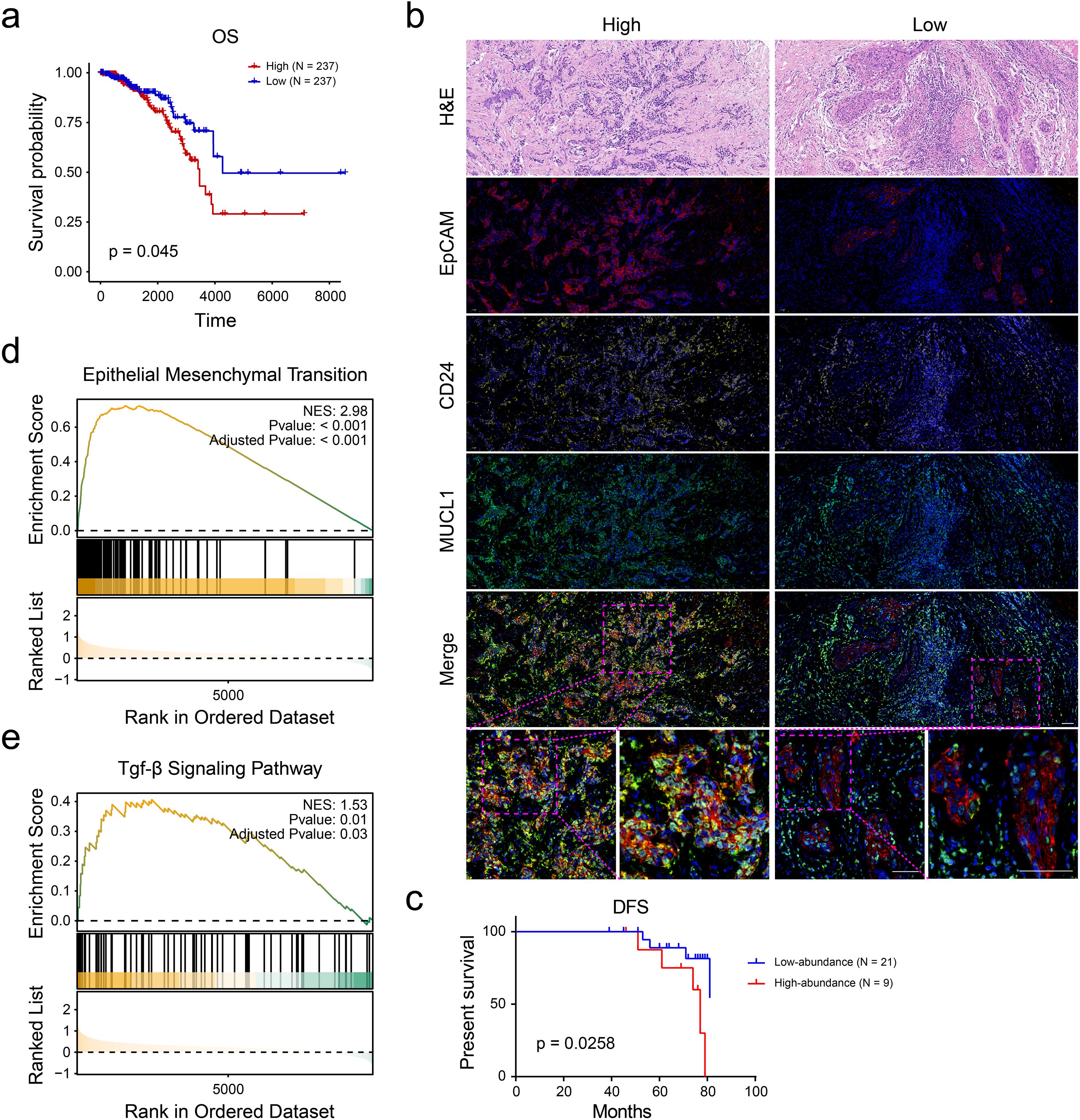 A composite image shows: a) Kaplan-Meier survival plot indicating overall survival (OS) for high and low groups, with a p-value of 0.045. b) Histological and immunofluorescence images comparing high and low expression in tissue sections using H&E, EpCAM, CD24, MUC1, and merged channels. c) Kaplan-Meier plot for disease-free survival (DFS) with a p-value of 0.0258. d) and e) Enrichment plots for Epithelial Mesenchymal Transition and TGF-β signaling pathways, showing enrichment scores and p-values.
