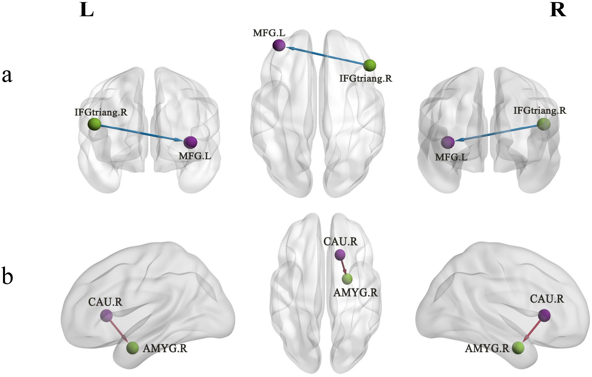 Illustration of brain connectivity with two panels. Panel a shows a lateral view with connections between the left middle frontal gyrus (MFG.L) and right inferior frontal gyrus (IFGtriang.R). Panel b displays connections between the right amygdala (AMYG.R) and right caudate (CAU.R) from a side view. Both panels highlight specific brain region links using colored spheres and lines.