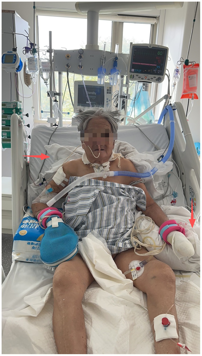 Patient in a hospital bed surrounded by medical equipment, including monitors and IV drips. The patient has various tubes and bandages, with a ventilator attached. Red arrows point to specific medical devices. The individual is covered with a striped sheet and has visible IV lines and monitoring devices on the arms and legs.