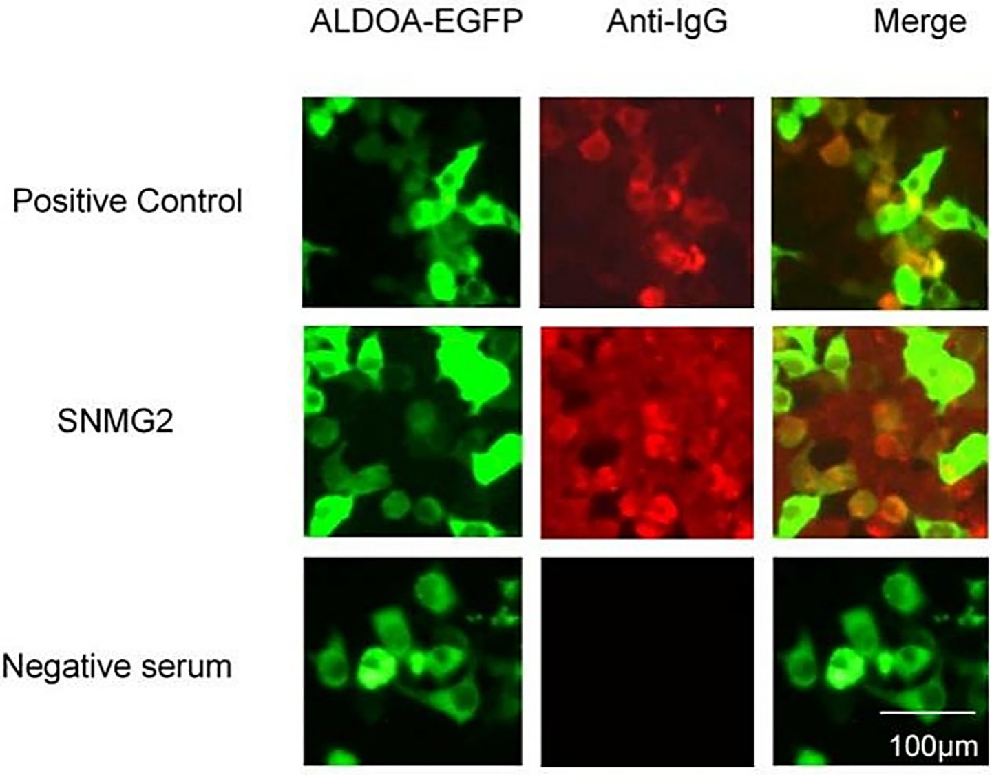 Fluorescent microscopy images in three rows labeled Positive Control, SNMG2, and Negative serum. Each row has three columns labeled ALDOA-EGFP, Anti-IgG, and Merge. Positive Control and SNMG2 rows show green and red fluorescence, with merged images displaying yellow. Negative serum illustrates only green fluorescence without red or yellow in the merged image. Scale bar: 100 micrometers.