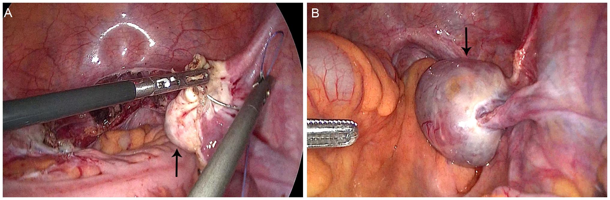 Two-panel image showing surgical images. Panel A displays laparoscopic instruments manipulating tissue with an arrow indicating a specific area. Panel B shows an enlarged view of a round mass, highlighted by an arrow pointing to it, indicating a focus on a specific anatomical feature.