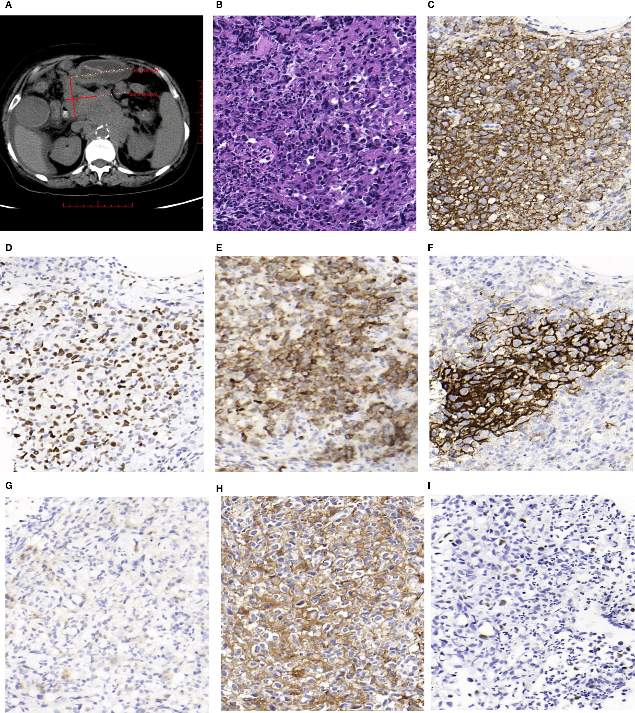 Panel A shows a CT scan of an abdominal area with measurements marked. Panel B presents a histopathological image with dense cell clusters stained purple. Panels C to I display various histological tissue stains, each with different levels of brown and blue staining, indicating protein expression and cellular details.
