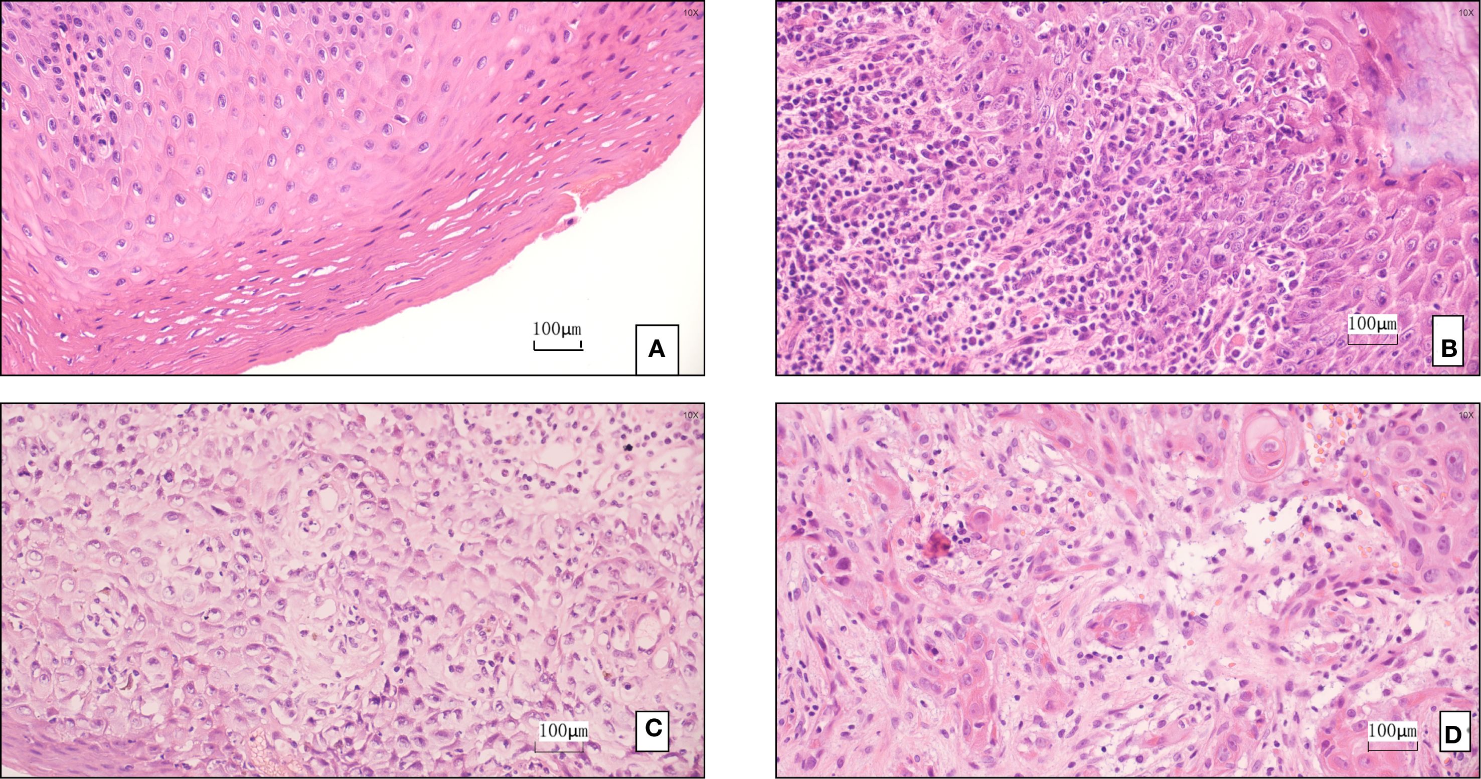 Histological images labeled A, B, C, and D, each at 10x magnification. Image A shows stratified squamous epithelium with uniform cell arrangement. Image B reveals dense cellular infiltration with some irregularities. Image C displays a loose cellular structure with larger, pale-stained cells, indicating increased extracellular space. Image D shows a mix of dense cell clusters and more fibrous areas, with occasional cellular atypia. Each image is marked with a 100-micrometer scale bar.