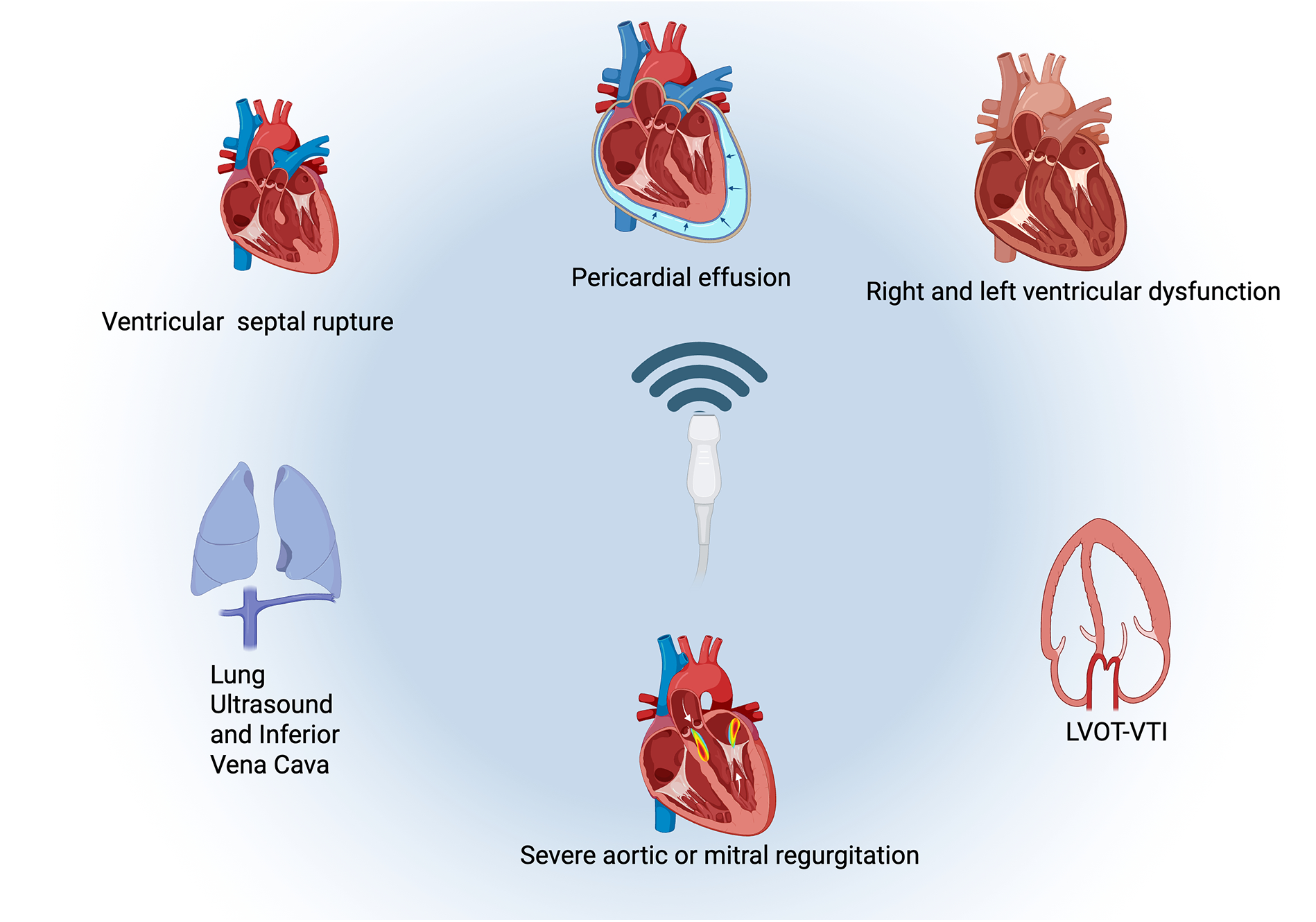 Diagram showing a central human heart with ultrasound waves, connected by arrows to images illustrating associated conditions. These include lung ultrasound and inferior vena cava, LVOT VTI, pericardial effusion, severe aortic or mitral regurgitation, ventricular septal rupture, and right and left ventricular dysfunction. Each condition is labeled beneath its respective image.