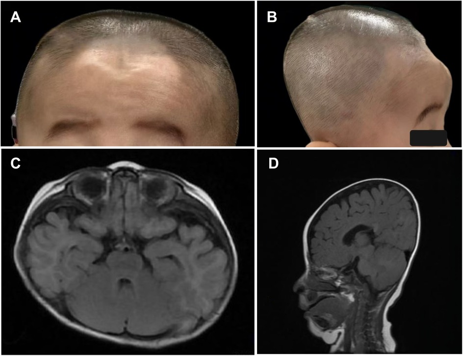 A four-panel image shows the following: Panel A depicts the front view of a person's forehead with a noticeable depression. Panel B shows the side view of the same person's head with a visible bulge on the forehead. Panel C is an axial MRI scan of a brain, highlighting brain structures. Panel D is a sagittal MRI scan of the brain, illustrating its profile and internal structures.