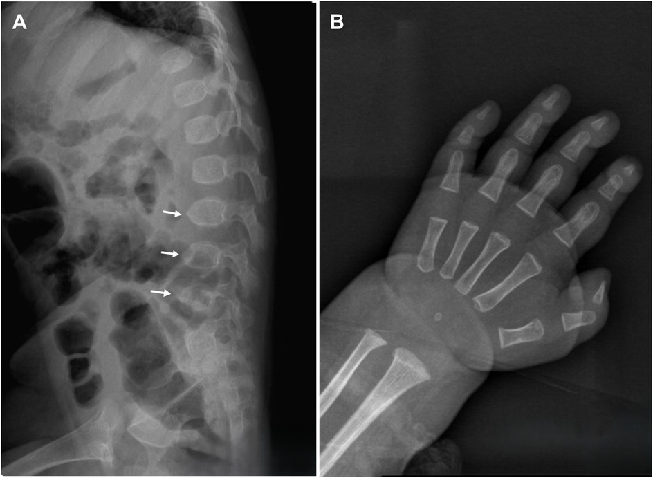 X-ray images showing two panels: Panel A highlights a lateral view of the spine with arrows indicating abnormalities in several vertebrae. Panel B displays an X-ray of a hand and wrist, revealing the bone structure and alignment.