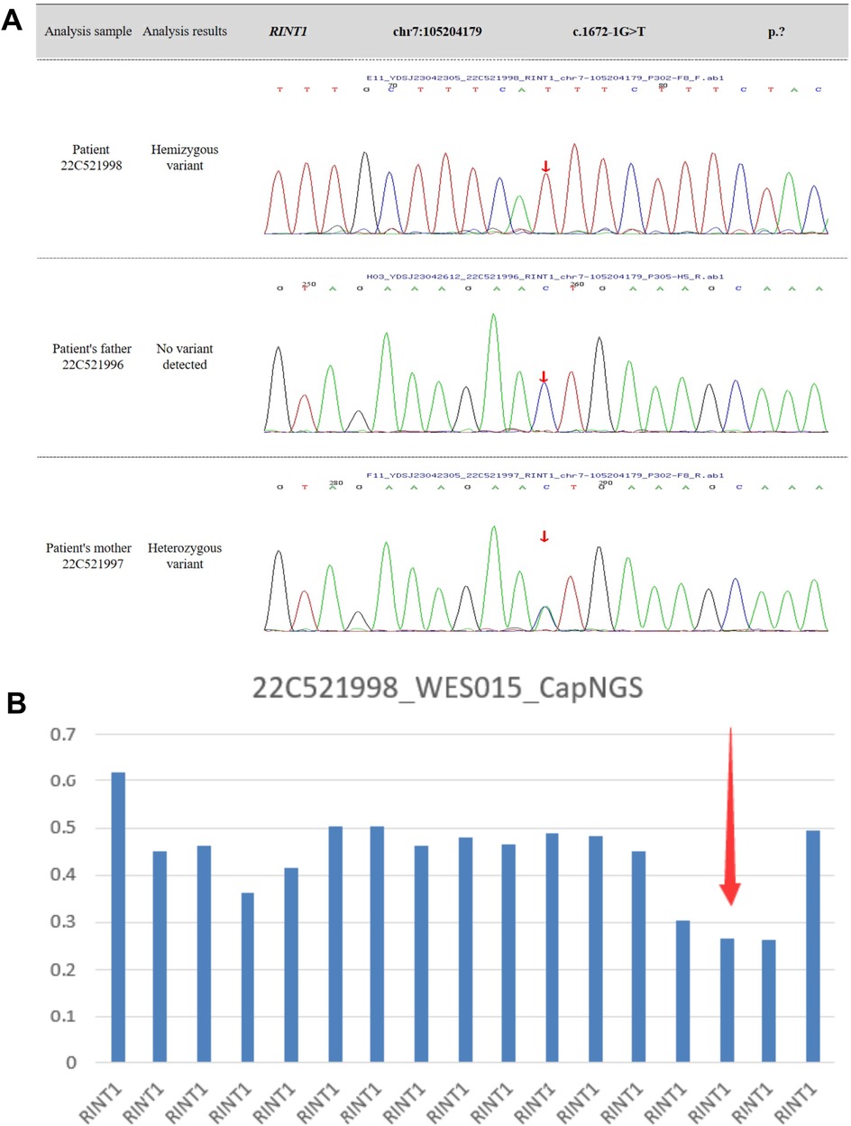 Panel A shows three electropherograms with sequencing results for the gene RINT1, highlighting a hemizygous variant in one patient, no variant in the father, and a heterozygous variant in the mother. Panel B presents a bar graph showing expression levels of RINT1, with one bar indicated by a red arrow.