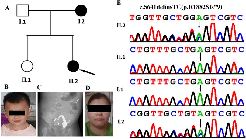 Pedigree chart and genetic analysis showing a family tree with affected and unaffected members. Panels B and D display photos of individuals with eyes obscured for privacy. Panel C shows an X-ray image. Panel E contains a DNA sequence graph indicating a c.5641delinsTC mutation.