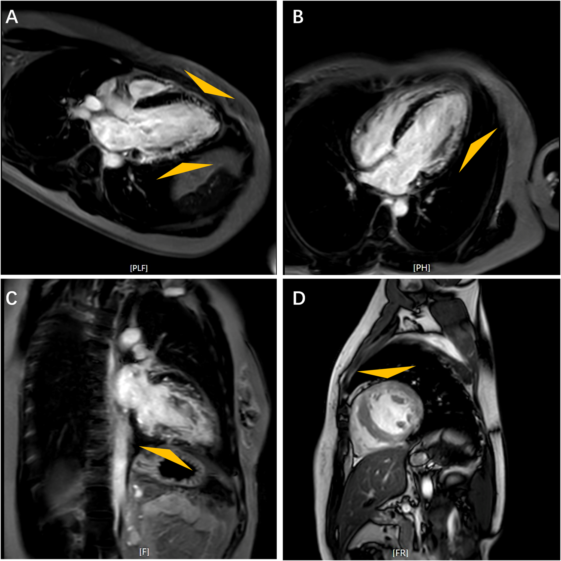 MRI showing different views of the heart: long axis in Panel A, horizontal long axis in Panel B, four-chamber view in Panel C and short axis in Panel D. Triangles highlight the LGE in ventricular walls.