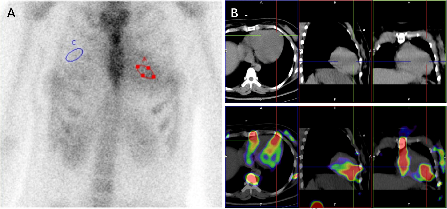 PYP-SPECT/CT images in comparison. Panel A shows the PYP scintigraphy of the patient, with outlined areas for calculation. Panel B shows the SPECT/CT scan, with false-colored images indicating the uptake of radionuclide.