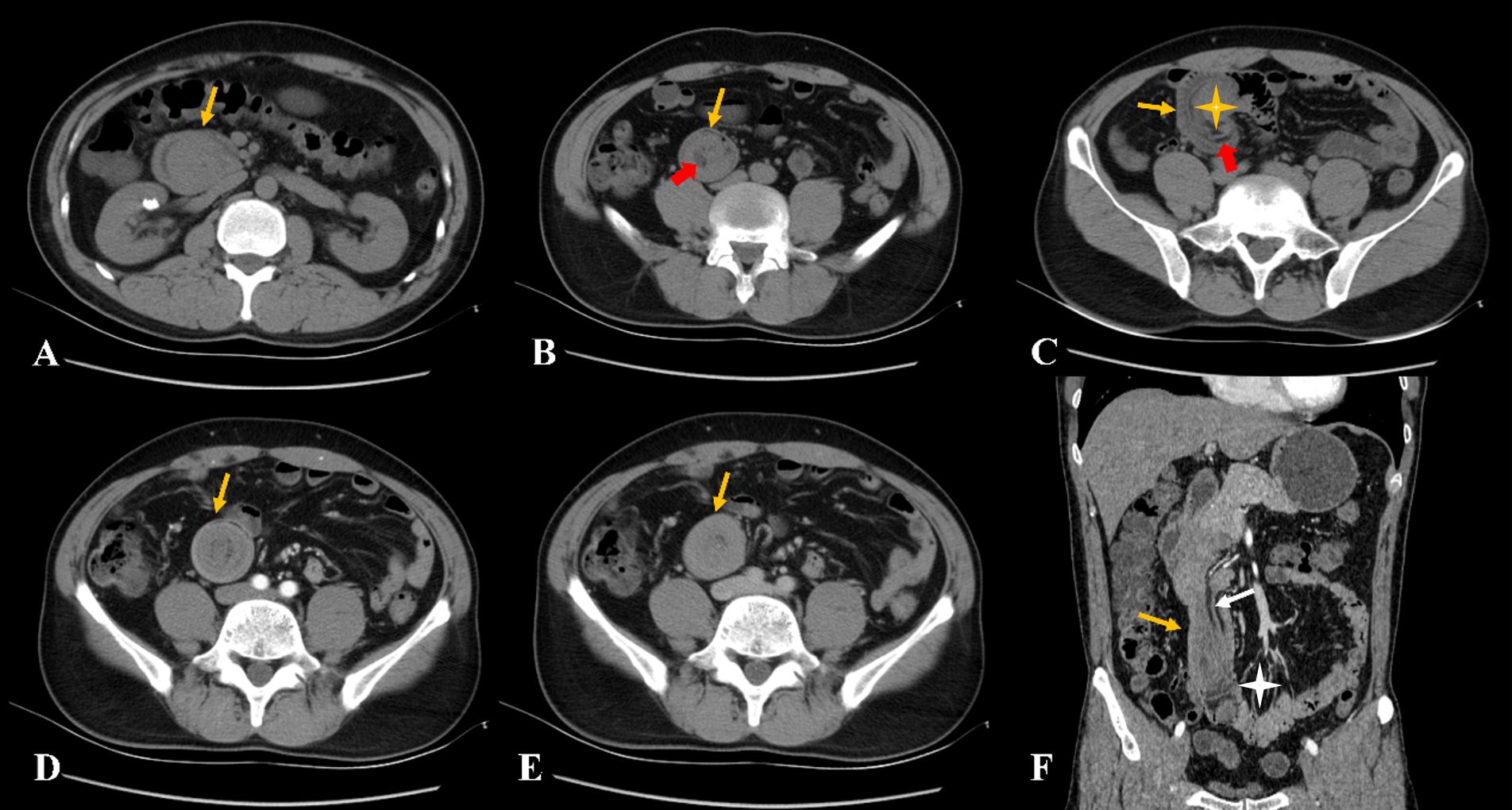 CT scans show cross-sectional and coronal views of the abdomen. Panels A to E highlight a mass indicated by yellow arrows, with panel B also featuring the mass with fat attenuation by a red arrow. Panel C includes a star and panel F shows both yellow and white arrows highlighting specific regions within the abdomen.
