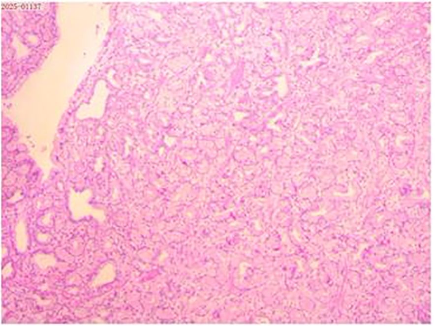 Microscopic image exhibits lobulated hyperplasia of Brunner’s glands, partitioned by smooth muscle bundles, with lymphocytic aggregates.
