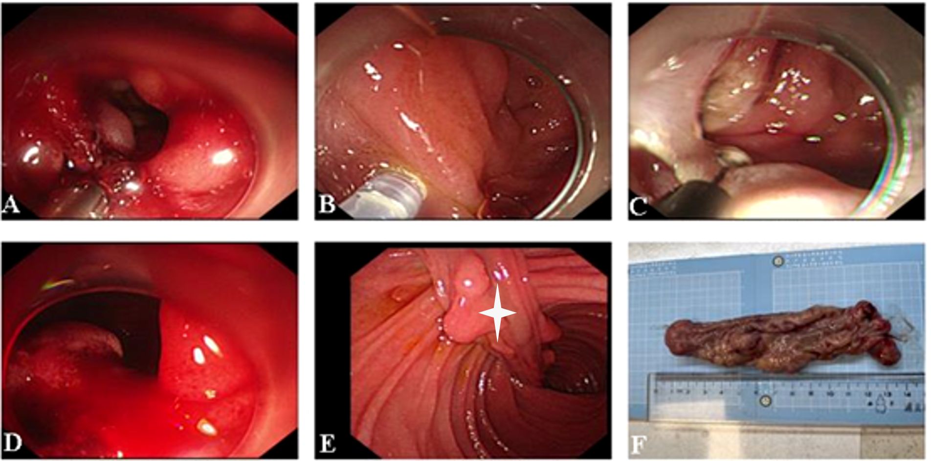 Images A to E show endoscopic views of a duodenal intussusception developing from a duodenal polyp. Image F displays the removed polyp placed on a measuring scale for reference.