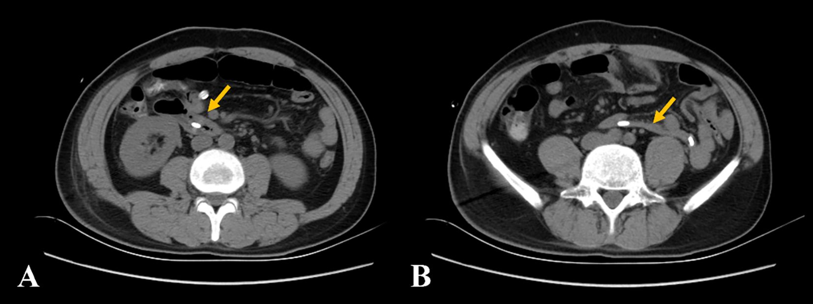 CT scan shows two abdominal cross-sections labeled A and B. Yellow arrows point to specific areas on each image, indicating the resolution of duodenal wall abnormalities with the restoration of normal anatomical position.