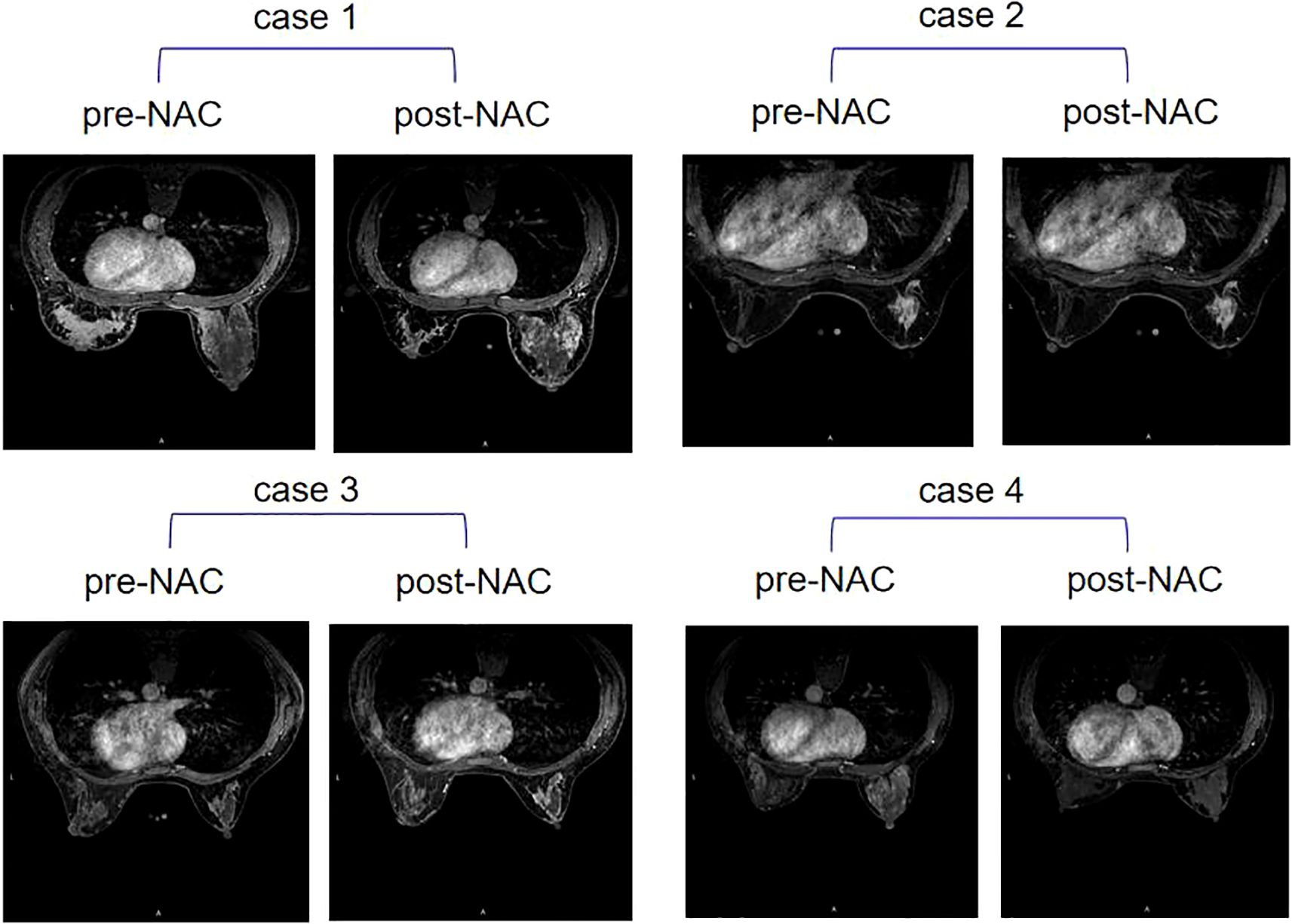 MRI images show pre- and post-neoadjuvant chemotherapy (NAC) results for four cases. Each pair demonstrates changes in background parenchymal enhancement(BPE) before and after NAC treatment. Cases 1 depict BPE staged high. Cases 2 depict BPE staged low. Cases 3 depict BPE changed from low to high. Cases 4 depict BPE changed from high to low.