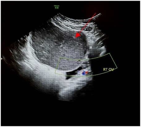 Ultrasound image showing a right ovary with an outlined area highlighted by a red arrow. The grayscale image includes annotations labeled \