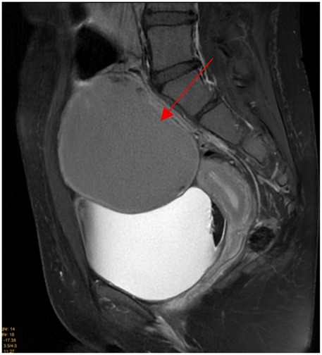 MRI scan showing a sagittal view of the pelvic region. A large, round, dark mass is visible in the bladder area, highlighted by a red arrow, indicating possible pathology.