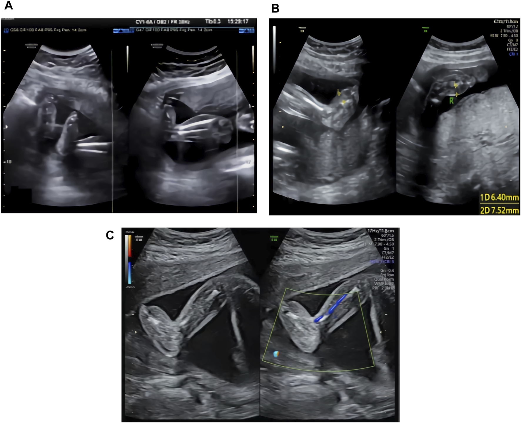 Ultrasound images showing fetal development in three panels. Panel A displays two side-by-side views of a fetus. Panel B shows two additional views, highlighting the measurement of a specific fetal feature. Panel C presents two views with Doppler color indicating blood flow, emphasizing a particular fetal area.
