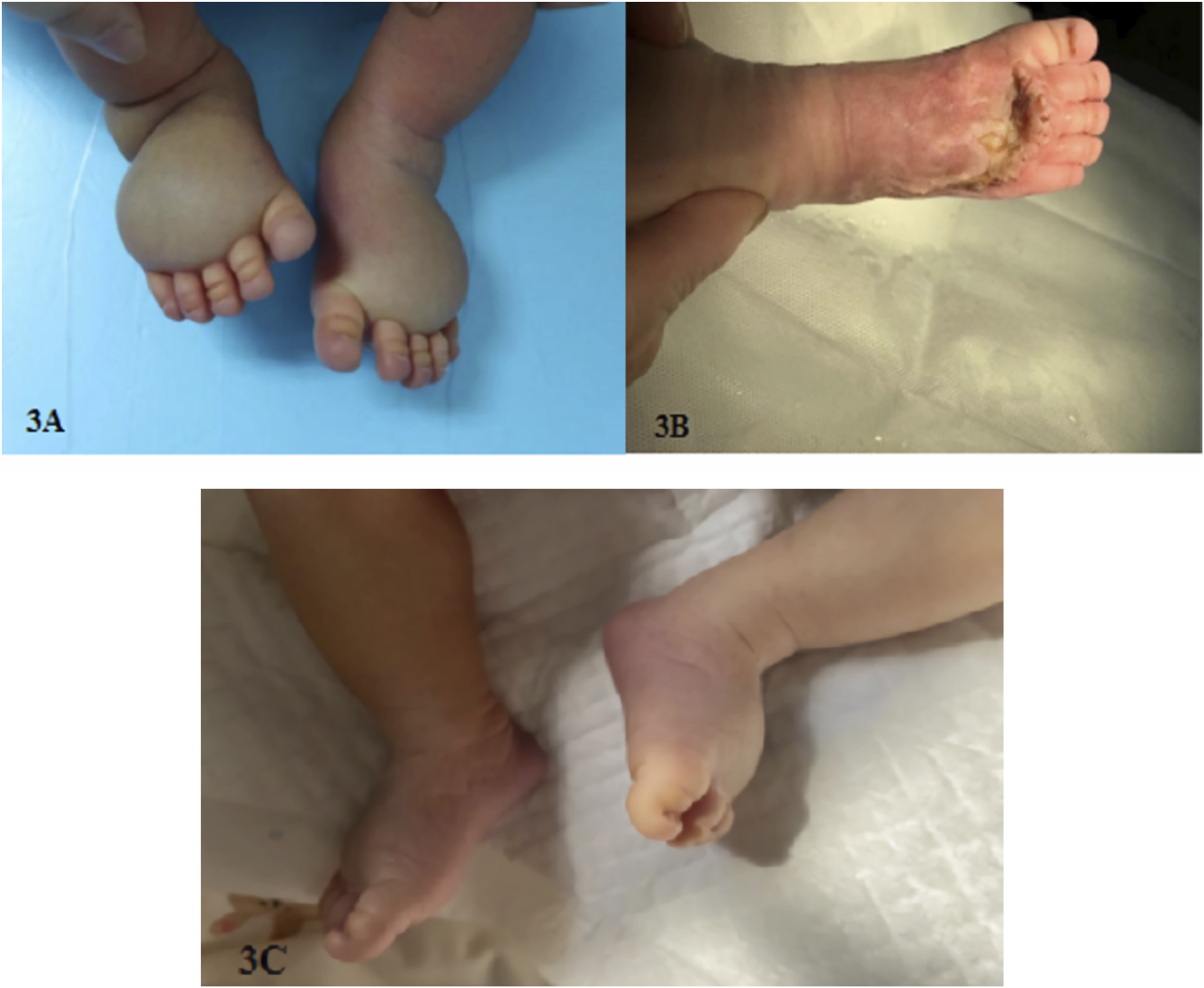 Three images labeled 3A, 3B, and 3C show two child’s feet. Image 3A depicts swollen feet of one child with a blue background. Image 3B shows the recovery foot of the same child after surgery. Image 3C presents the feet with a mild edema in another child, lying on a white surface.