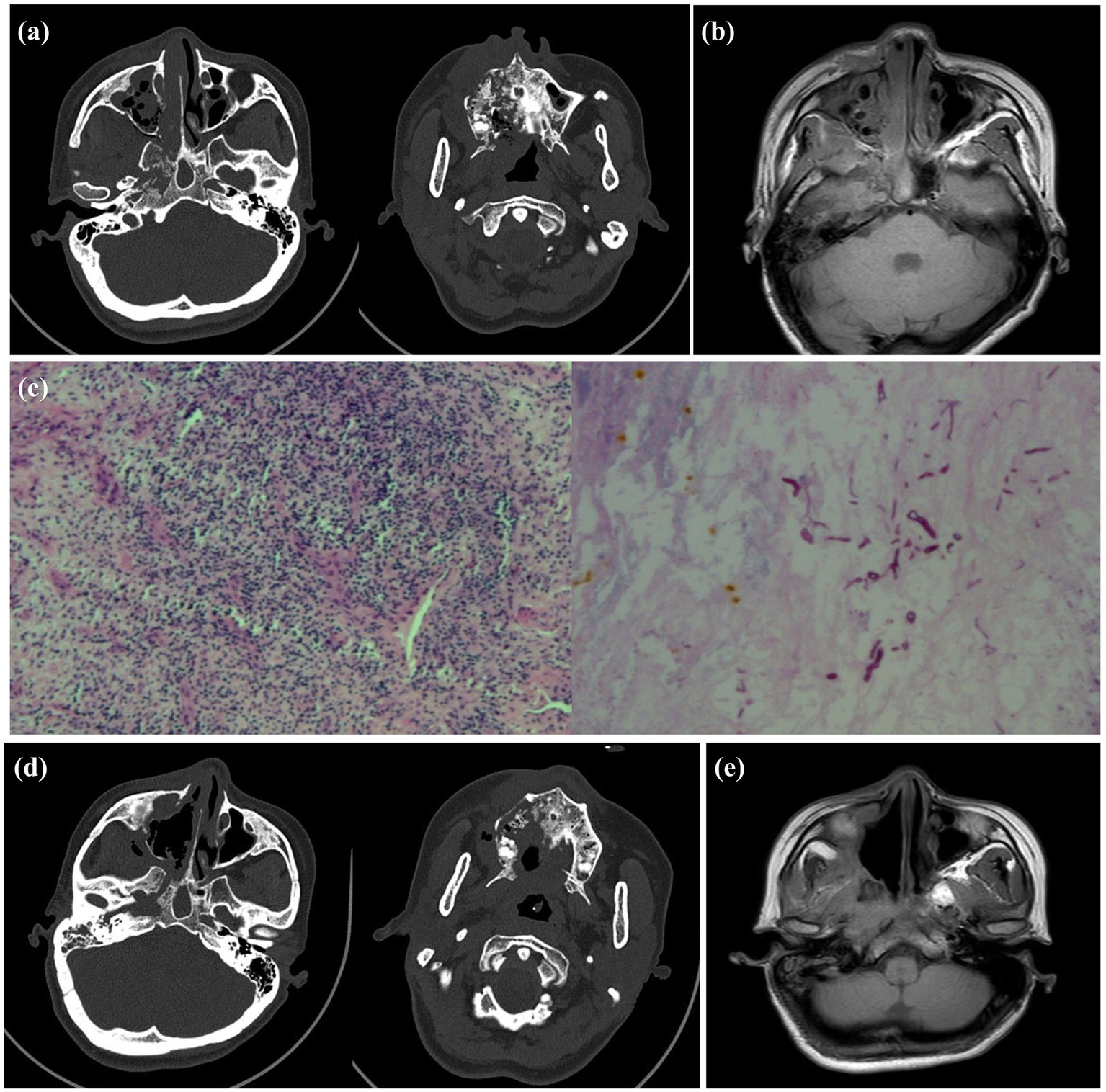 (a) Two axial CT scans showing different planes of a head with evident structures. (b) An axial MRI image displaying detailed soft tissue contrasts of the head. (c) Microscopic view of tissue, showing densely packed cells on the left and sparse cells with purple staining on the right. (d) Two more axial CT scans similar to (a) with slight variations. (e) An axial MRI complementing (b), illustrating a different plane with similar soft tissue detail.