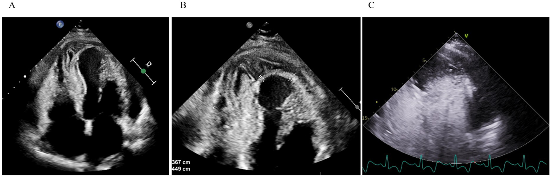 Three-panel transthoracic echocardiographic images labeled A, B, and C. Panel A shows apical four chamber view of the heart with apical and inferoseptal myocardial thickening with a large, echolucent, spindle-shaped intramyocardial cavity, without evident communication to cardiac chambers or pericardial space. Panel B displays a zoomed-in four-chamber view of the apical region. Panel C includes an apical four-chamber view with contrast in the left-ventricular cavity without communication with hematoma.