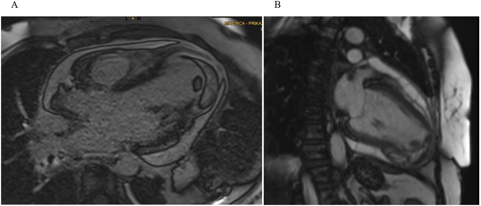 MRI images labeled A and B. Panel A shows a four-chamber and panel B a two-chamber view with a well-demarcated hypointense lesion within the inferoapical left-ventricular wall extending into the septum, consistent with intramyocardial hemorrhage and a clearly defined intracavitary thrombus visible at the left-ventricular apex.