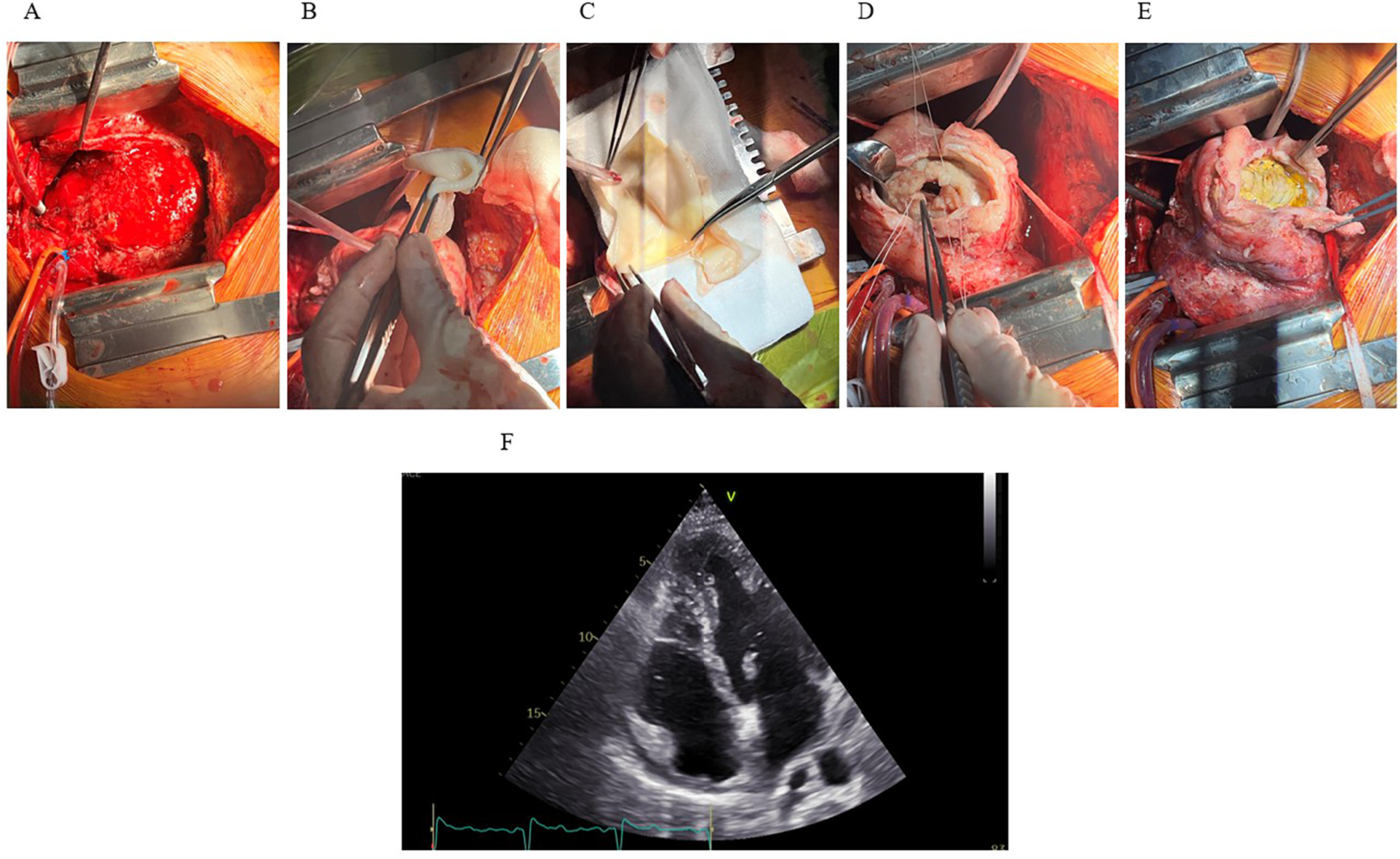 A series of images shows a surgical procedure. Panel A depicts an exposed surgical site. with the heart exposed, showing extensive hematoma and inflammation involving the inferoapical myocardial region. Panels B and C show a synthetic patch for reconstruction of the LV geometry. Panel D illustrates exposed LV cavity following resection of infarcted and necrotic myocardium. Panel E highlights the completed positioning and fixation of the synthetic patch. Panel F shows a postoperative transthoracic echocardiography (apical four-chamber view) with successful resolution of the IDH and intracavitary thrombus, with only residual apical hypokinesis.