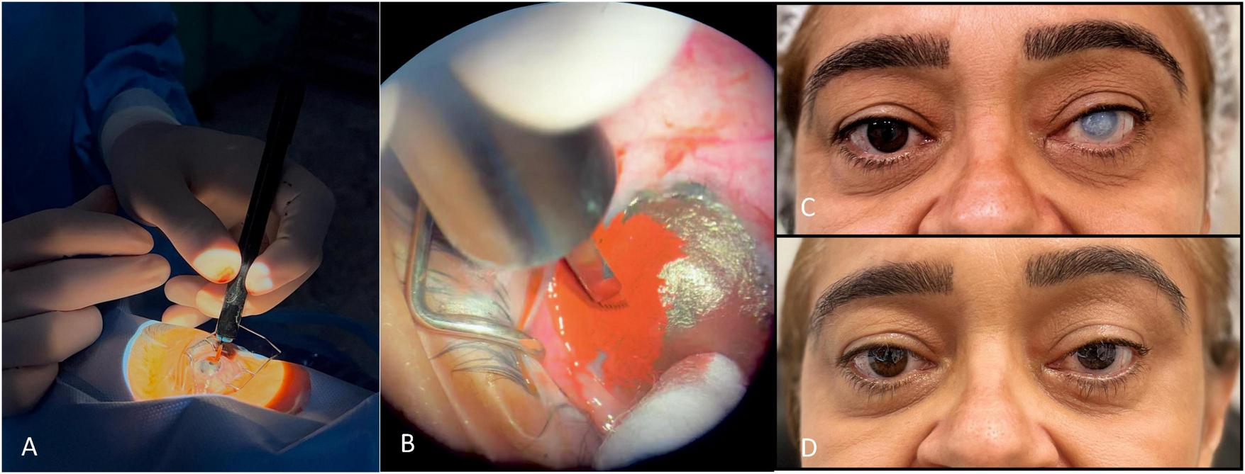 A series of images depicting ophthalmic surgery (Superficial manual keratopigmentation using the “Tebori de Garotti” technique) and patient results. A: Surgeon performing eye surgery using a tebori. B: close-up of pigment implantation. C: Patient with a cloudy preoperative eye. D: Same patient post-surgery with final healed result.
