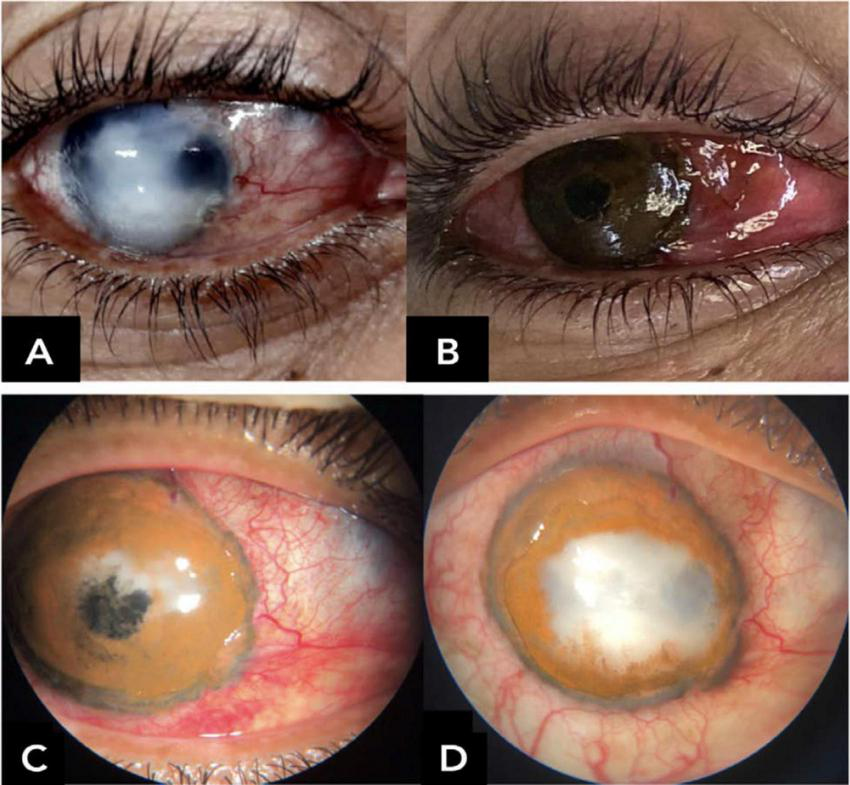 Four images of human eyes labeled A, B, C, and D. Image A shows an eye with a white, opaque cornea indicating severe opacity. Image B displays an immediate postoperative pigmented eye . Image C depicts the pigmented eye with a little white spot. Image D shows significant pigment loss with corneal opacity with a white, cloudy appearance, with remaining of the pigments in the periphery. All images highlight different degrees an early central corneal ulceration and melting with pigment loss within the first postoperative days, associated with corneal hypoesthesia and suggestive diagnosis of necrotizing herpetic keratitis.