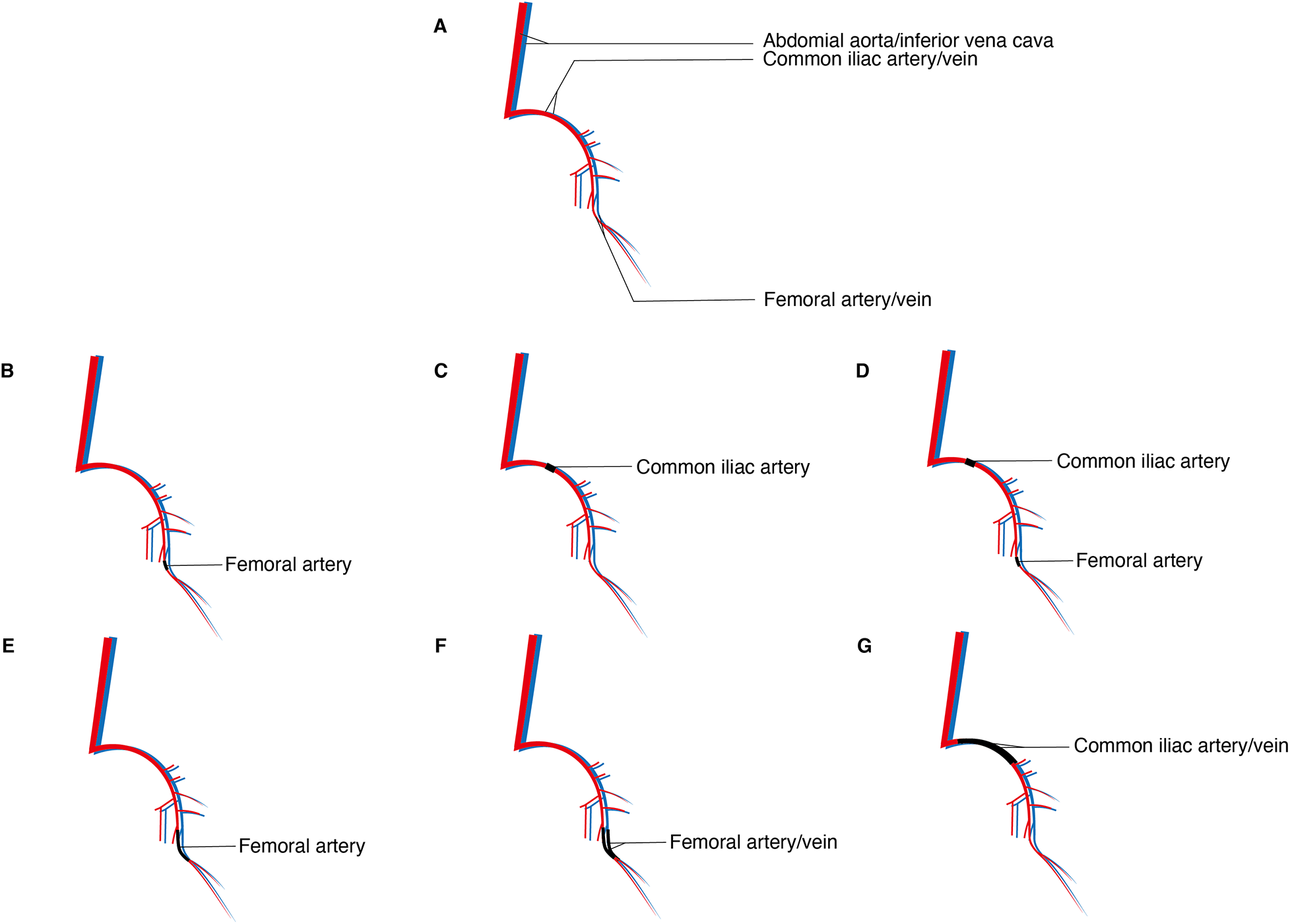 Diagram showing seven illustrations of vascular anatomy. Panel A labels the abdominal aorta, inferior vena cava, common iliac artery/vein, and femoral artery/vein. Panels B to G focus on different parts of the vasculature, sequentially highlighting the common iliac artery and femoral artery/vein with labels indicating specific structures in each illustration.