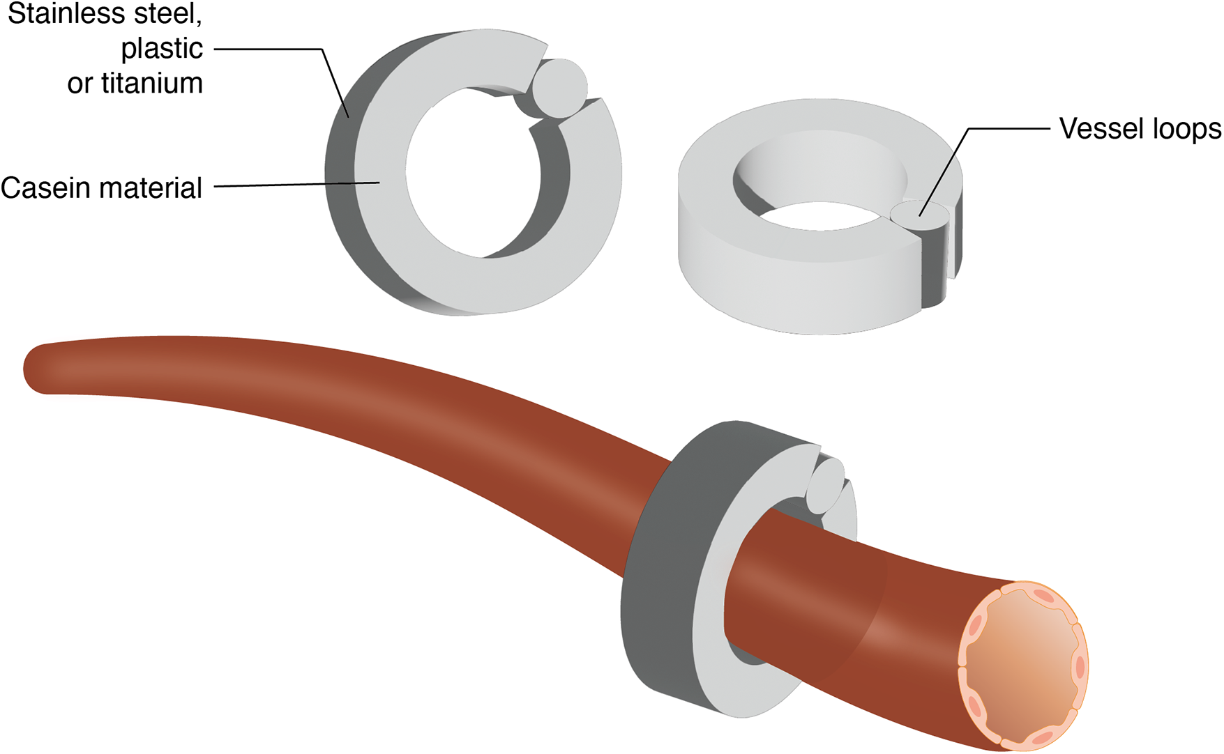 Diagram showing a cross-section of a vessel with a clamp placed around it. The clamp is made of stainless steel, plastic, or titanium and incorporates casein material. Vessel loops are part of the system. The image highlights the materials used in the clamp construction.