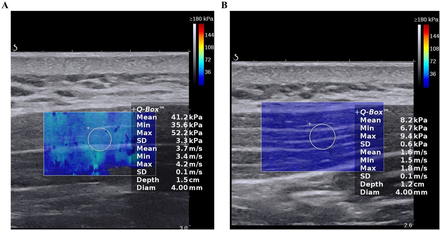 Two ultrasound elastography images labeled A and B. Image A shows elasticity values with a Q-Box containing mean values of 41.2 kPa and 3.7 m/s, and a measurement circle. Image B shows lower elasticity values with mean values of 8.2 kPa and 1.6 m/s, and a similar measurement circle. Both images include color scales and measurement metrics.