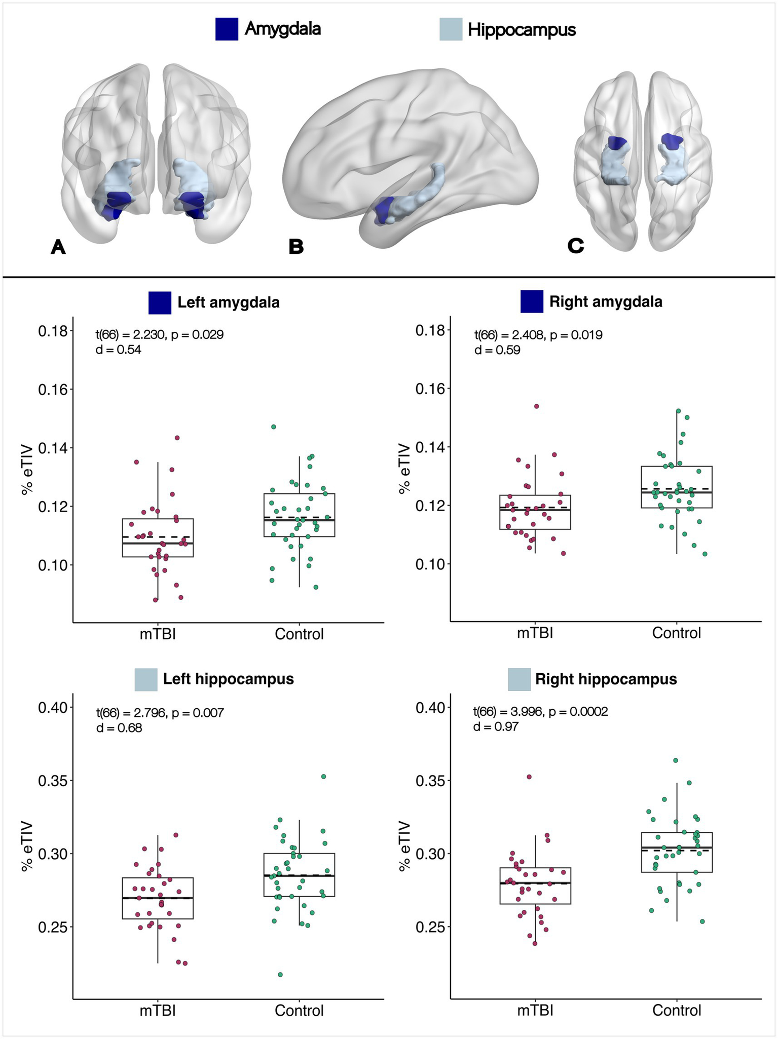 Top row shows brain diagrams highlighting the amygdala and hippocampus. Bottom row displays box plots comparing mTBI and control groups for left and right amygdala and hippocampus percent effective total intracranial volume (%eTIV). Statistical values are included for each comparison.