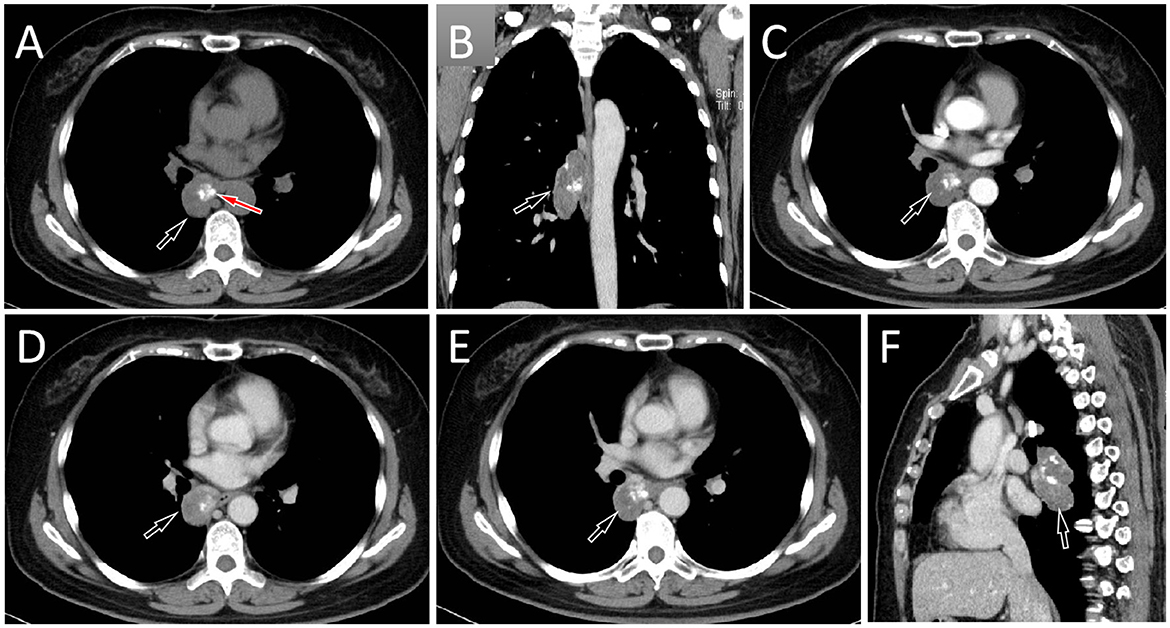 CT scan images in panels A to F show a thoracic mass indicated by arrows. Panels A, C, D, and E display axial views, panel B a coronal view, and panel F a sagittal view. The mass appears to be located in the mediastinum, proximal to the heart and trachea.