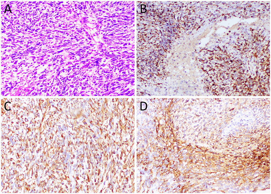 Histological images in four panels labeled A to D. Panel A shows a section stained with hematoxylin and eosin, highlighting dense clusters of cells. Panels B, C, and D display immunohistochemical staining with varying intensities of brown, indicating different levels of protein expression in the tissue sections.