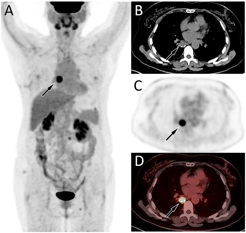 Medical imaging series showing PET-CT scans of the body. Image A displays a full-body scan with highlighted areas. Image B shows a transverse CT scan indicating a lesion in the chest. Image C presents a PET scan with increased uptake. Image D combines PET and CT data, showing a bright spot in the chest region indicating high metabolic activity. Arrows point to areas of concern.