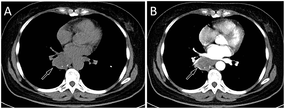 Two CT scan images labeled A and B show cross-sections of the thorax. Both images highlight the heart and surrounding structures. Arrows indicate specific areas of interest near the spine, likely pointing to a notable anatomical or pathological feature. Image A shows a darker contrast compared to Image B.