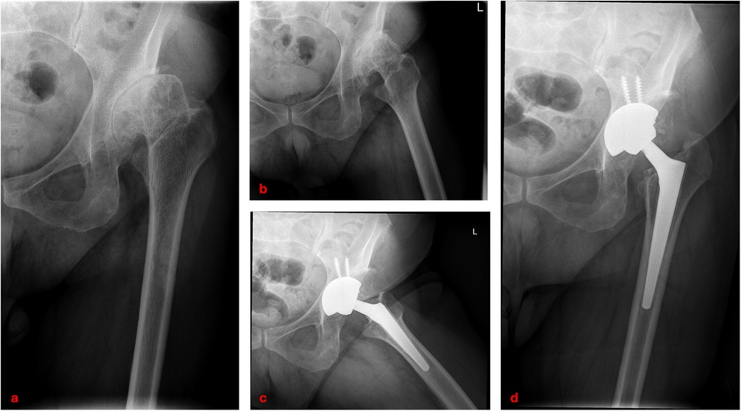 X-ray images showing different views of a hip joint. Image (a) and (b) depict the hip joint before surgery, revealing bone degradation. Images (c) and (d) show the hip after joint replacement surgery, with a metal prosthesis in place.