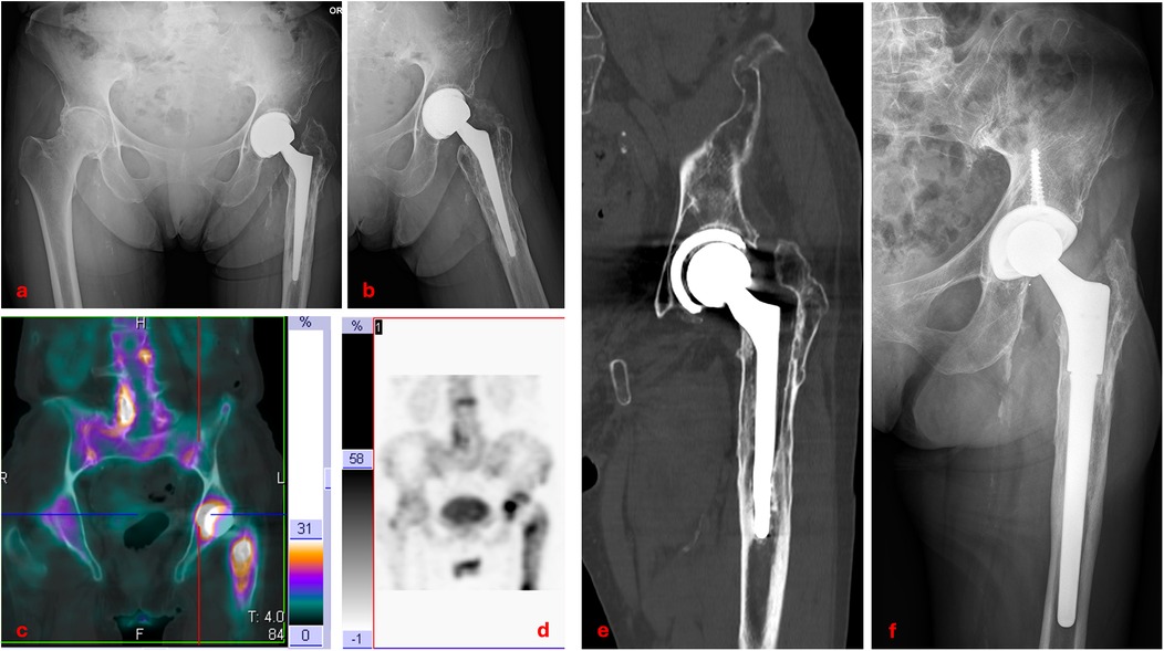 A series of medical images showing a hip joint replacement. Image a: X-ray of the pelvis frontal view with hip prosthesis. Image b: X-ray of the right hip lateral view with prosthesis. Image c: PET scan with highlighted areas, showing differing densities. Image d: Blurry PET scan focused on the hip region. Image e: CT scan of the hip displaying the prosthetic joint in detail. Image f: X-ray of the right hip with an updated prosthetic model.